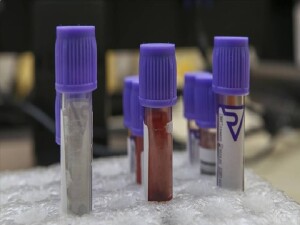 Yeni kan testi, ölümcül kanser hastalarına umut olabilir