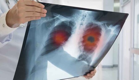 Güney Kıbrıs’ta kanser vakaları son 3 yılda yüzde 20 arttı
