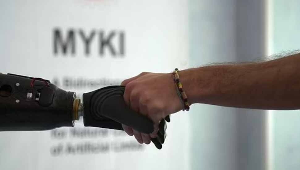 Güney Kıbrıs’ta sol elini kaybeden hastaya biyonik el takıldı