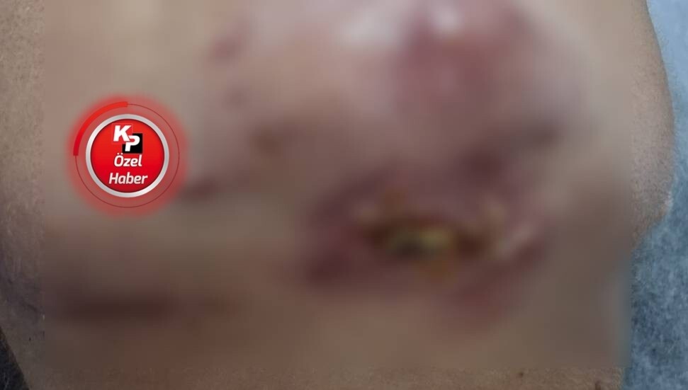 Dolgu işleminden sonra yüzü enfekte oldu: Yedi aydır bu acıyla yaşıyorum, muhatap bulamıyorum